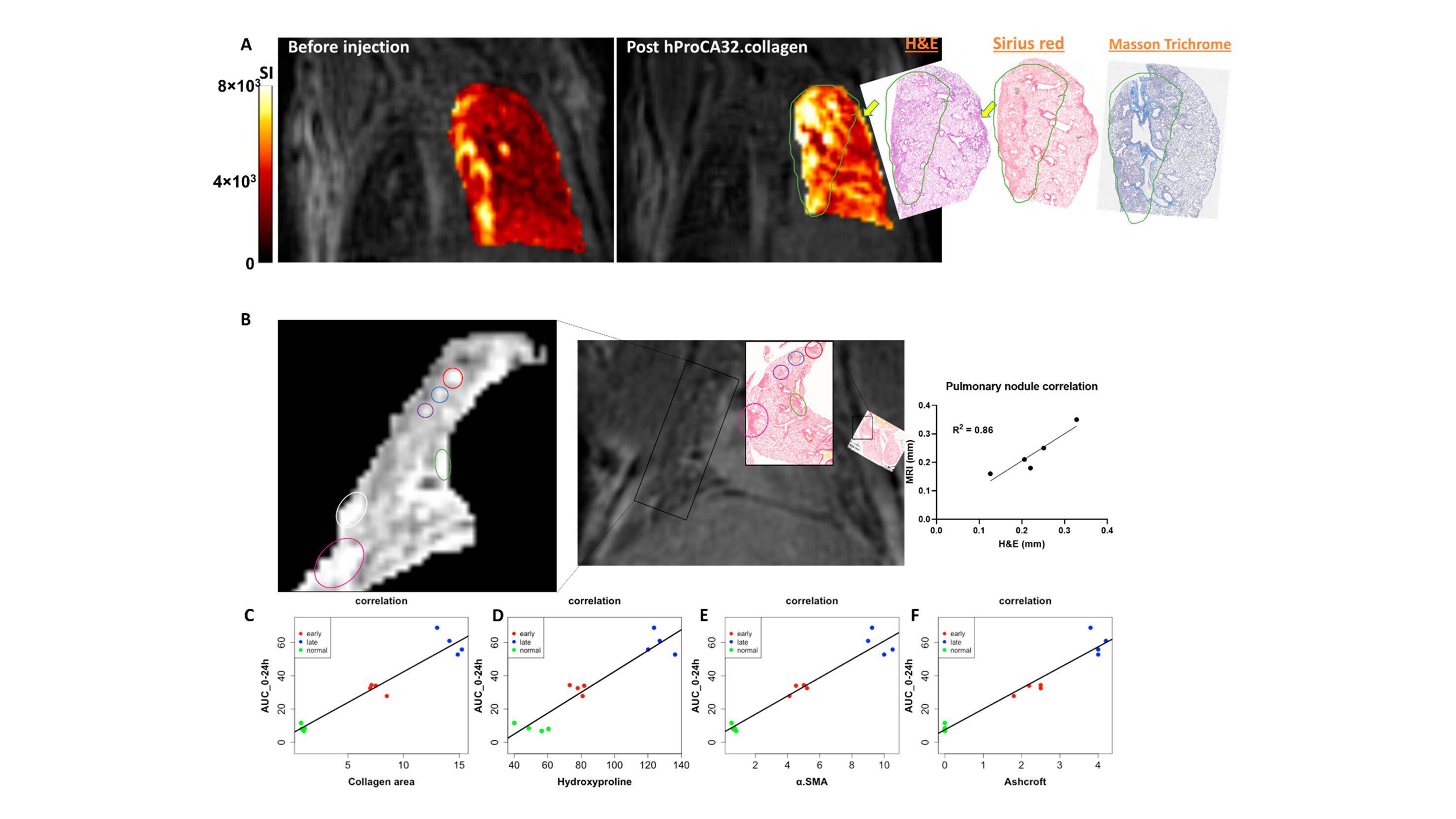 Early detection and staging of lung fibrosis enabled by collagen-targeted MRI protein contrast agent